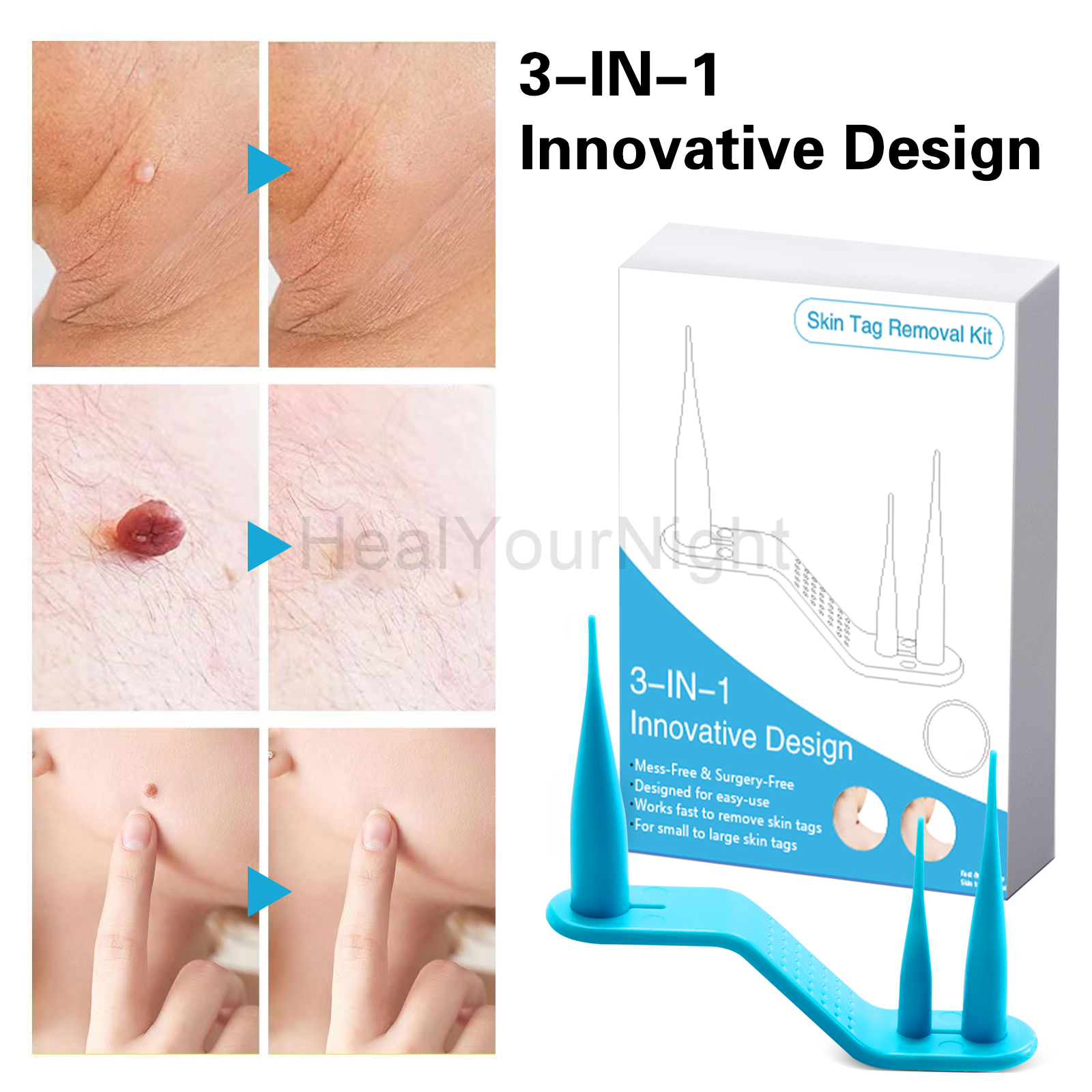 3-IN-1 Auto Skin Tag Removal K - Acne Light Therapy Pen incelemesi ve fiyatı