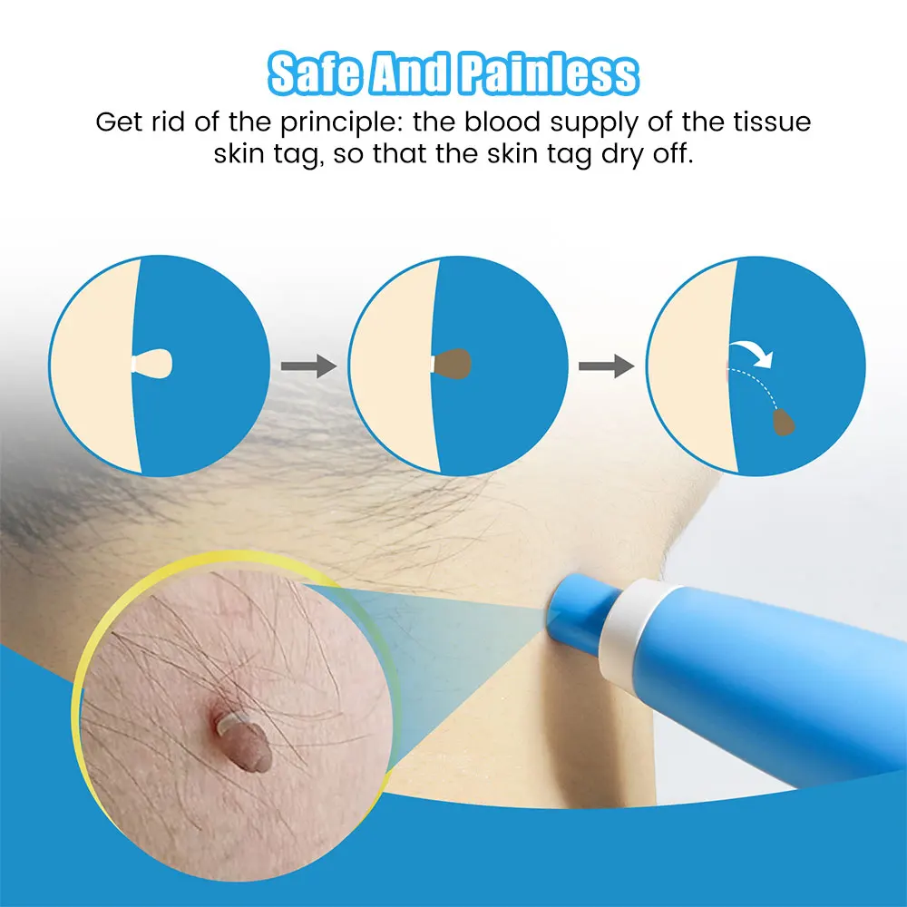 Auto Skin Tag Removal Tool Kit - Acne Light Therapy Pen incelemesi ve fiyatı